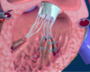 Duke Health Pioneers Two World-First Pediatric Heart Procedures