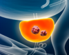 Radiopharmaceutical Therapy Leads to Dramatic PSA Reduction for Patient with Metastatic Prostate Cancer