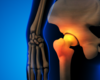 Cutting-Edge Technologies Enhance Joint Replacement