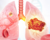 Expertise, Research Extend Treatment Options for Small Cell Lung Cancer