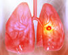 Autotransplantation a New Option To Treat Complex Lung Tumors