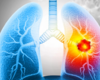 Duke Offers Expertise in New Immune Therapy for Advanced Small Cell Lung Cancer
