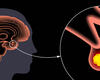 Multiple Comorbid Conditions Vanish After Pituitary Tumors Resected