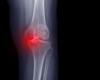Partial Knee Replacement Offers Patients More Options