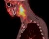 Advances in Metabolic Imaging for the Treatment of Head and Neck Cancer