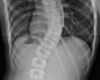 Novel Procedure Reduces Spinal Curvature in Patients With Scoliosis