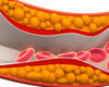  Cholesterol Guidelines Recommend More Aggressive Therapies 
