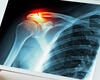 High-Tech Approaches Can Improve Shoulder Surgery Outcomes