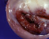 Along with human papillomavirus infection, what is another risk factor for the carcinoma seen here?