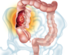 Managing Patients With Colorectal Liver Metastases