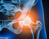Hip Dysplasia in Adolescents and Young Adults