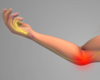 The Role of Nerve Transfer Surgery in Severe Cubital Tunnel and High Ulnar Nerve Injuries