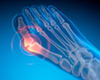 Advancements in the Workup and Treatment of Hallux Valgus Deformities