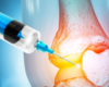 Orthobiologic Injections Offer Safe Nonsurgical Treatment