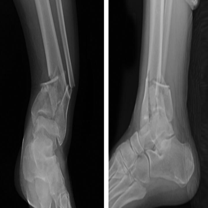 Initial injury radiographs, right ankle 