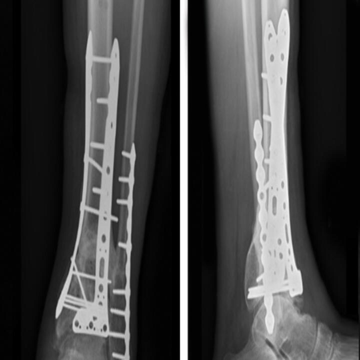 Radiographs of left ankle taken six months postop