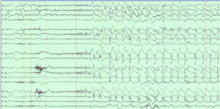 EEG showing seizure from the right side of the brain