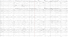 EG showing abnormal brain activity in between seizures from the right side of the brain