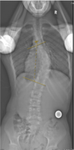 Preoperative curve of 45 degrees