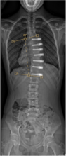 6 weeks postoperative curve of 22 degrees