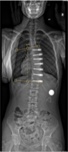 6 month postoperative curve of 15 degrees