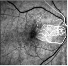 This image shows a delay in the filling of the retinal arteries in the affected areas (fluorescein angiography). 