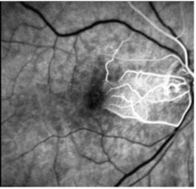 This image shows a delay in the filling of the retinal arteries in the affected areas (fluorescein angiography).