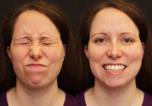 Figure 1: Facial movement before tumor re-resection