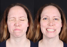 Figure 3: Patient's paralysis was resolved to near-normal nerve function after facial reanimation surgery