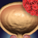 Illustration of cancer cell in prostate
