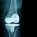 Xray of knee replacement