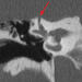 Corneal CT scan showing dehiscent semicircular canal