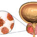 Illustration of prostate cancer cell
