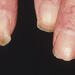A rash associated with dermatomyositis 