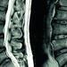 Scan of lumbar spine