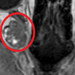 Scan showing cavernoma in patient's brain