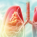 Illustration of lung cancer