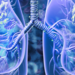 Lung cancer 3d illustration