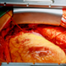 View of the heart inside the chest cavity