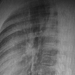 Lateral CXR showing pectus excavatum
