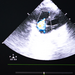 A screen of an ultrasound device with a heart scan and tricuspid regurgitation shown