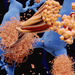 Alzheimer's disease: the amyloid-beta peptide accumulates to amyloid fibrils that build up dense amyloid plaques.