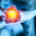 Pancreatic cancer is cancer that forms in the cells of the pancreas.