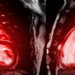 Cardiac MRI of heart compare RVOT and LVOT for diagnosis heart disease.