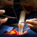 Heart Surgery Aortic Valve and Ascending Aorta Replacement