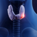 Thyroid gland cancer, 3d illustration