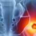 Hip bone cancer or tumor, one side pain. 3d illustration