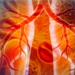 Medical Illustration showing lung cancer or bronchial carcinoma on medical background