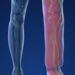 Medical animation depicting limb lymphedema
