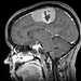 MRI of meningioma preop